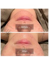 ドクターエイチ 麻布十番店(Doctor.H)/にきびケア