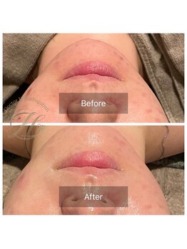 ドクターエイチ 麻布十番店(Doctor.H)/にきびケア