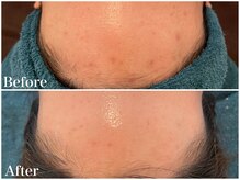 サロンドフェイス(Salon de Faith)/【ハーブピーリング】10回施術♪