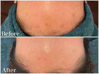 サロンドフェイス(Salon de Faith)/【ハーブピーリング】10回施術♪