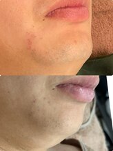 フェルン(FERUN)/メンズ脱毛