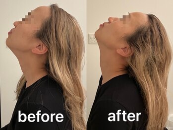 ヴィセラ(Vicella)/首の可動域アップ