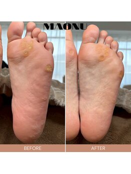 マオヌー(MAONU)/韓国式足裏角質ケア　症例写真
