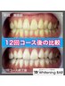 【名古屋NO.1の照射時間☆】1回あたり¥4190！ホワイトニング12回コース¥55200