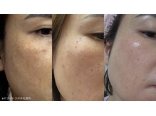 ブレデ フクオカ(B’lady Fukuoka)/次世代シミケア【ホワイトラボ】