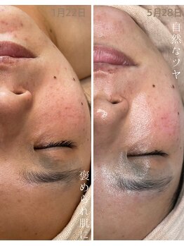 ミハン ボーテ(mihan.beaute)/【ニキビ・赤み】