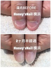 ハニーズネイル(Honey's Nail)/深爪改善経過