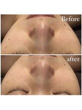 プルケルスパ(PULCHER SPA)/毛穴ケア！