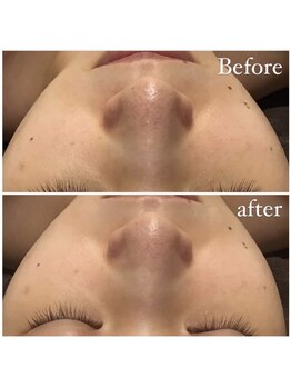 プルケルスパ(PULCHER SPA)/毛穴ケア！