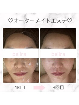 ベルラ(BELLRA)/最強リフトマシンと小顔リンパ