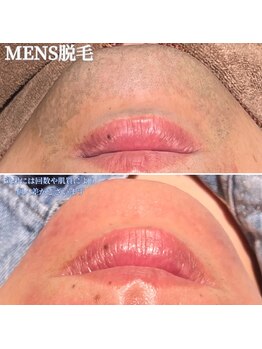 フォルチェ 久留米(Folche)/メンズ脱毛