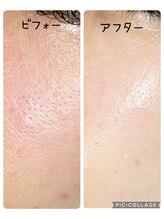 アトラ(Atora)/陶器肌☆