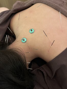 ハリマジック 代官山(HARI MAGIC)/【代官山/鍼灸/美容鍼】