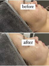 サラ(Sarah)/ハーブピーリングREVI