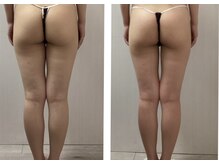 BBC 田園調布/【痩身】下半身/ヒップ+太もも