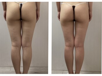 BBC 田園調布/【痩身】下半身/ヒップ+太もも