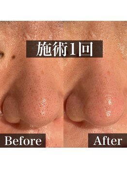 ラノン(LANON)/ビフォーアフター11