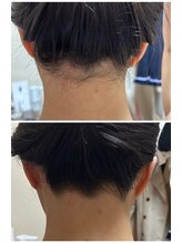 スキンケアスタジオ アコ 新宿店(Aco)/ソフトシェービング例