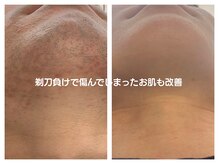 ルミエールブランシュ(Lumiere blanche)の雰囲気（《髭脱毛》剃刀で傷んでしまったお肌も改善◎）