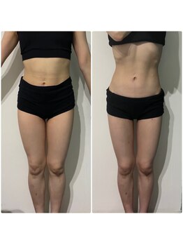 OBS新潟整骨院/脂肪冷却ビフォーアフター！