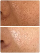 アデル(Adele)/リブセラフェイシヤル