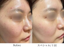 ビボーラ(BEBEAURA)/☆スペシャルプログラム☆