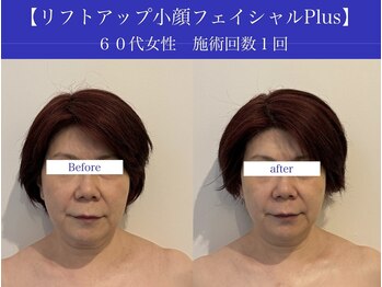 リプロ(RePro)/60代 ビフォーアフター