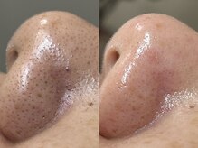 フレーズ(fraise)/毛穴エクストラクション