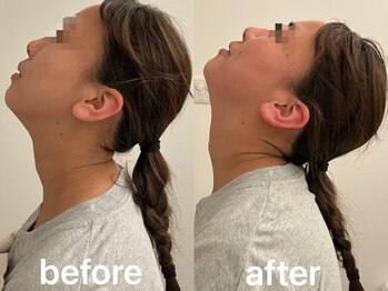 ヴィセラ(Vicella)/首の可動域アップ