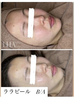 ミセルビューティー 御堂筋本町(micell beauty)/ララピール