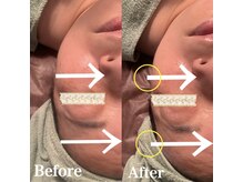 ルーチェ(LUCE)/小顔リフトUP/小顔矯正/筋膜