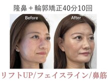 ラプリ 梅田店(Raplit)/隆鼻＋輪郭矯正40分10回