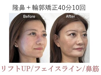 ラプリ 梅田店(Raplit)/隆鼻＋輪郭矯正40分10回
