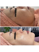 ベルフィーヌ ノーブル(BELLEFINE noble)/シミケアしながらリフトアップ