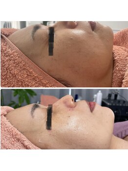 ベルフィーヌ ノーブル(BELLEFINE noble)/シミケアしながらリフトアップ