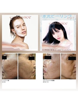 エテル(eter)の写真/【長年のしみシワ改善】皮膚の専門機関から生まれたエクスビアンス水光ピールで透明感のあるうるツヤ肌へ