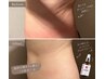 【即・効果的】脂肪分解セラム導入《お腹》×セルゼロ分解マシン60分11,000円