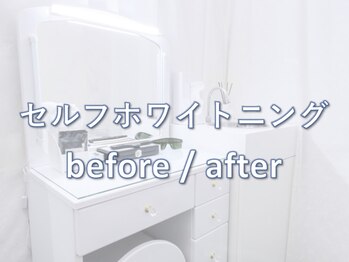 ライトケアサロン 銀座店(Light Care Salon)/セルフホワイトニングの症例写真