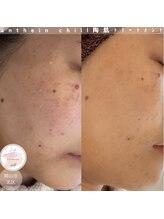 アンテイン チル(anthein chill)/陶肌トリートメント