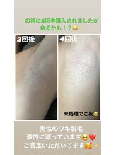 リコリナ(LikoLina)/ワキ脱毛
