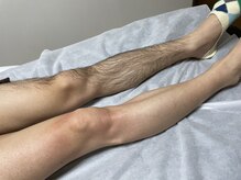 ミロクビューティーガーデン(MirokuBG)/脚WAX脱毛