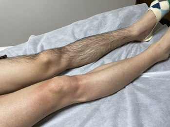 ミロクビューティーガーデン(MirokuBG)/脚WAX脱毛