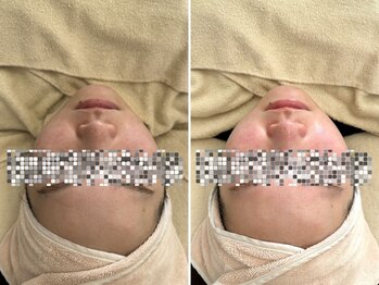 マヴィ くずは店(MavY.)/リフトアップして明るい肌へ!