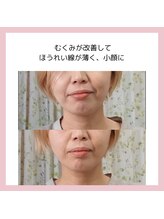 目元 口元のたるみ 眉間シワ改善専門サロン/ほうれい線を改善したい方向け☆