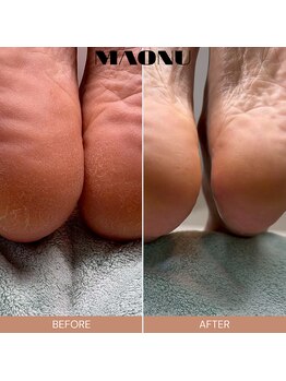 マオヌー(MAONU)/韓国式足裏角質ケア　症例写真