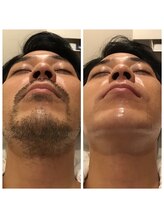 メンズ エステティック ヒーロー(men's esthetic HERO)/ヒゲWAX