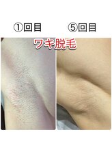 ブランニュー(brand new)/男性★ワキ脱毛