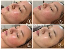 化学物質など一切使用していない100%天然ハーブグリーンピール