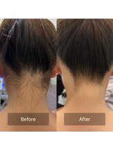 オベリオ(Oberio)/うなじ脱毛