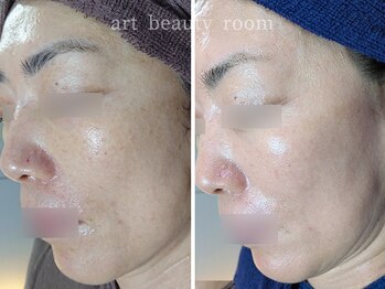 アート ビューティールーム(art beauty room)/☆OPL 光フェイシャル & ダクト
